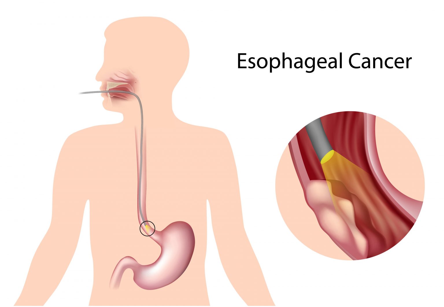 Undergoing Surgery For Esophageal Cancer “10 Important Things You Need To Know” Laparoscopic