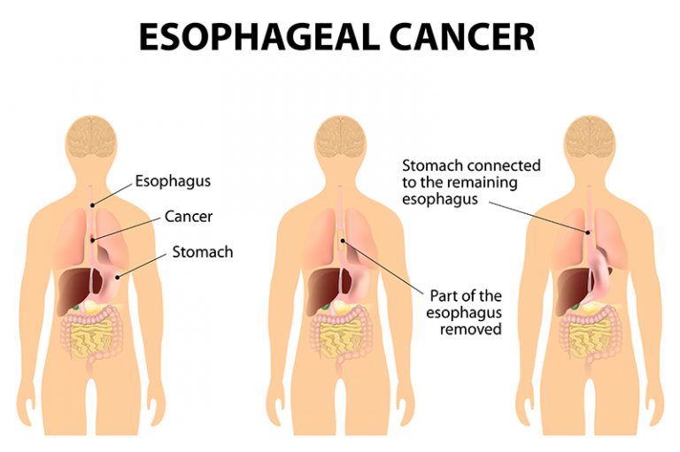 esophageal-cancer-and-tumors-symptoms-causes-laparoscopic-cancer