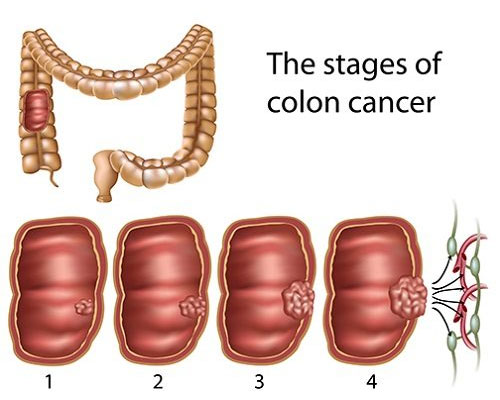 best doctor for colon cancer in delhi