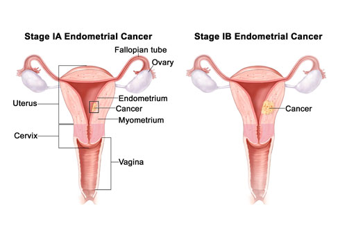 endometrial cancer specialist in delhi