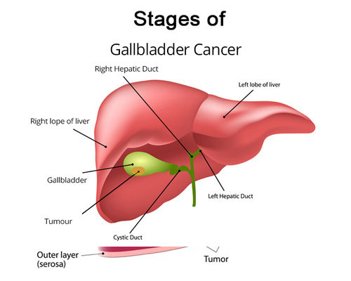 best oncologist for gallbladder cancer in delhi