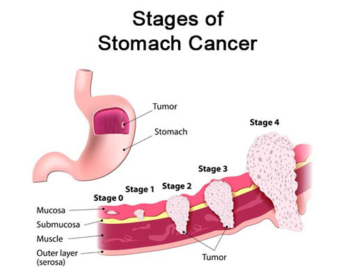 best stomach cancer doctor in delhi