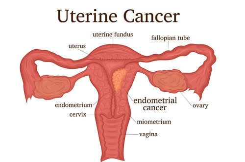 uterine cancer surgeon in delhi