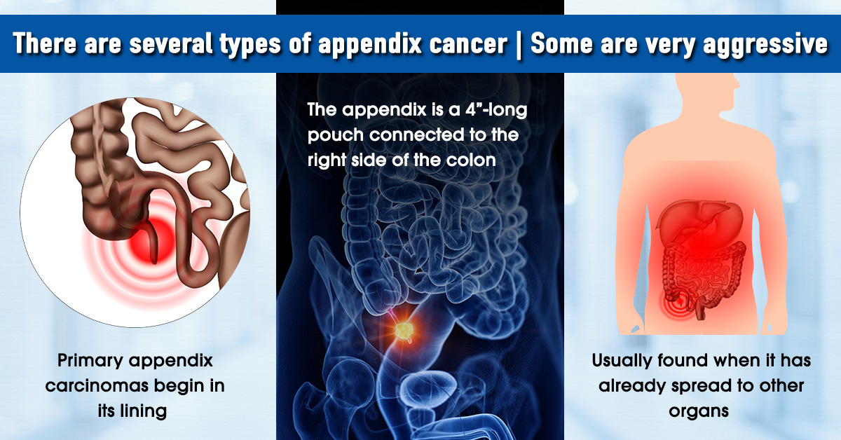 appendix cancer doctor in south delhi