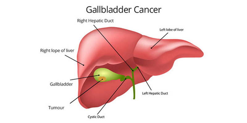best doctor for gallbladder cancer in delhi