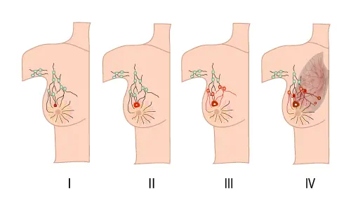 best breast cancer oncologist in Delhi