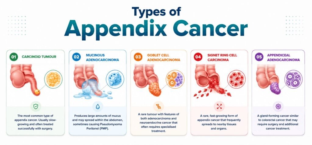 Types of appendix cancer - explained by Dr. Archit Pandit, one of the best cancer doctor in Delhi.